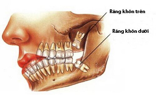 Nhổ răng khôn có nguy hiểm không? 3