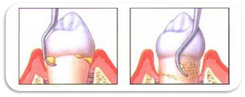 cạo vôi răng có bị chảy máu không