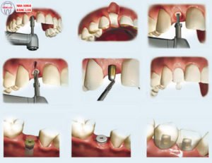 Trồng răng giả vĩnh viễn có thật hay không? 3