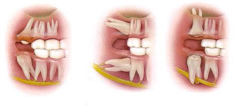 Nhổ răng khôn xong bị sốt nguy hiểm không? 3