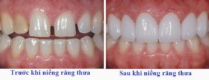 Niềng răng giá rẻ tại TP.HCM 1