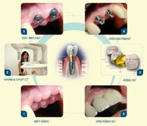 Quy trình thực hiện Implant răng cửa 2