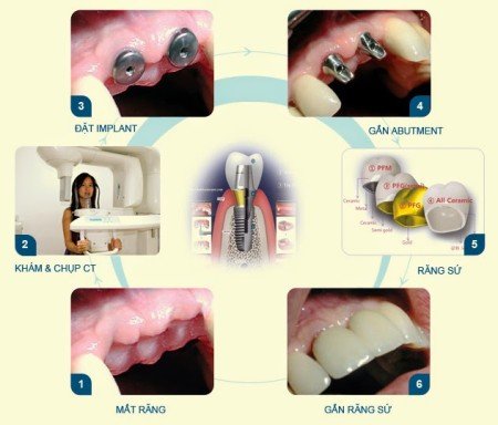 Cấy ghép răng Implant có tốt không? 1