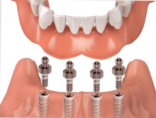 Dịch vụ cấy ghép implant tại trung tâm nha khoa 3