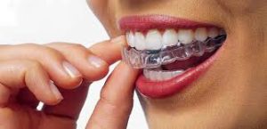 Niềng răng invisalign có đau không? 1