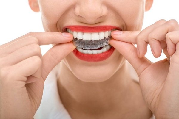 Ưu điểm vượt trội của niềng răng không mắc cài invisalign 3