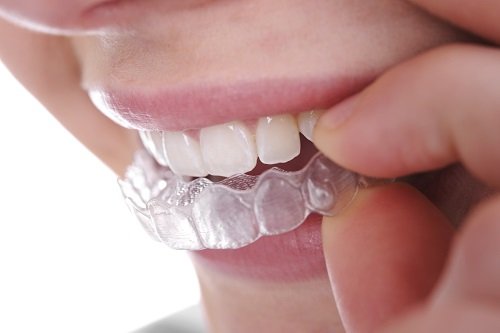 Ưu điểm vượt trội của niềng răng không mắc cài invisalign 2