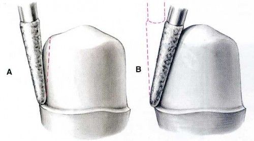 boc-rang-su-la-gi-2