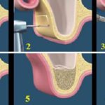 nang-xoang-ham-trong-cay-ghep-rang-implant-1