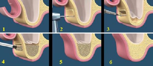 nang-xoang-ham-trong-cay-ghep-rang-implant-1