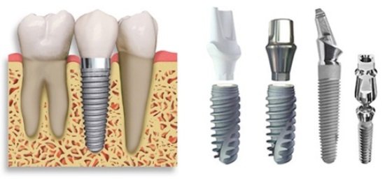 nang-xoang-ham-trong-cay-ghep-rang-implant-3