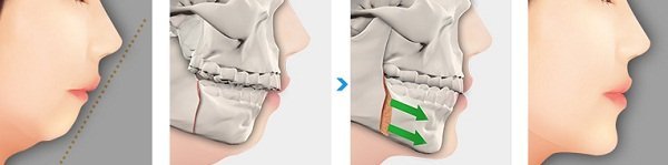 Phẫu thuật hàm hô có ảnh hưởng sức khoẻ không?