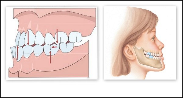 Phẫu thuật hàm vẩu hiệu quả với kỹ thuật Bsso