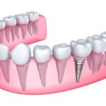 thoi-gian-cay-ghep-rang-implant-bao-lau-1