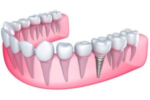 thoi-gian-cay-ghep-rang-implant-bao-lau-1