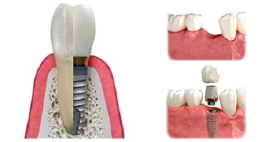 thoi-gian-cay-ghep-rang-implant-bao-lau-2