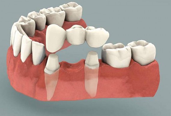 Trồng răng giả có đau không? 2