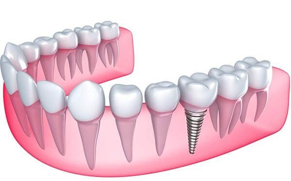 Trồng răng giả có đau không? 1