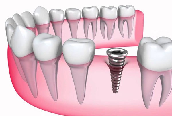 lam-rang-implant-mat-bao-nhieu-tien-1