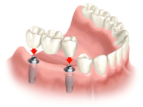 trong-rang-implant-gia-re-3