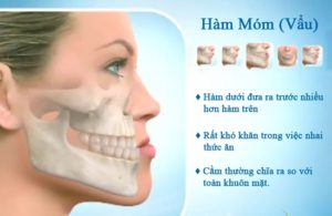 phau-thuat-vau-ham-duoi-1