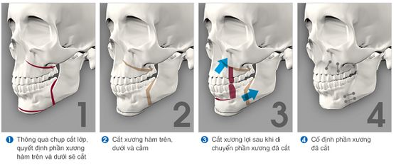 phau-thuat-vau-ham-duoi-2