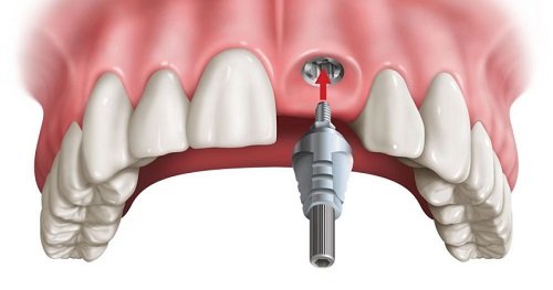 Trồng răng cửa hàm trên cần lưu ý điều gì? 1