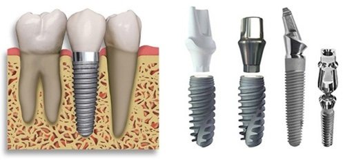 Trồng răng cấm hết bao nhiêu tiền? Tìm hiểu giá cả 3