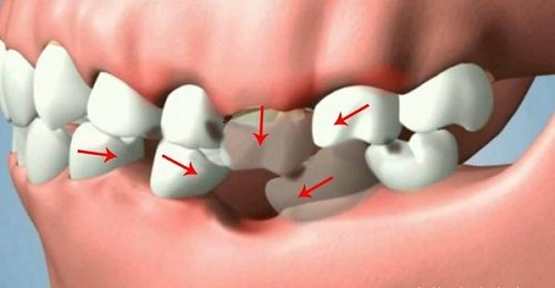 Trồng răng có nhanh không? Dựa vào đâu để biết 1