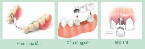 Trồng răng có nhanh không? Dựa vào đâu để biết 3