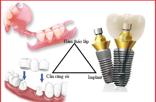 Trồng răng cửa bao nhiêu tiền? Tìm hiểu chi phí hợp lý 3