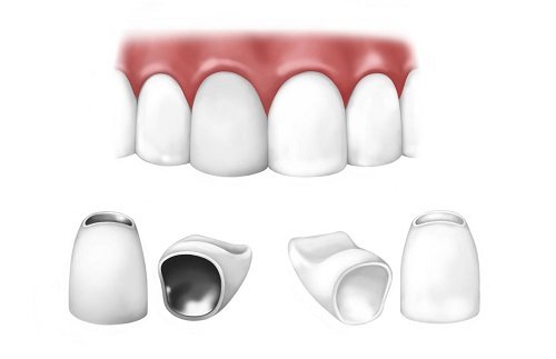 Kết luận: Có nên trồng răng sứ kim loại không? *