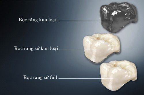 Răng sứ loại nào tốt nhất trên thị trường hiện nay? 1