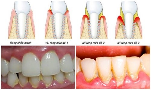 Lấy cao răng bao nhiêu tiền? Tham khảo thông tin liên quan 3