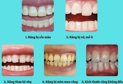 Làm răng sứ không mài răng - Tìm hiểu ngay 3