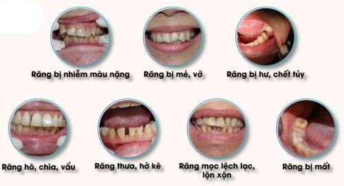 Bọc răng sứ giữ được bao lâu? Nha khoa tư vấn 2