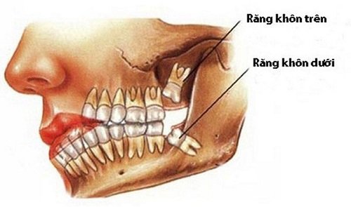 Mọc 4 cái răng khôn cùng lúc phải làm sao? 1