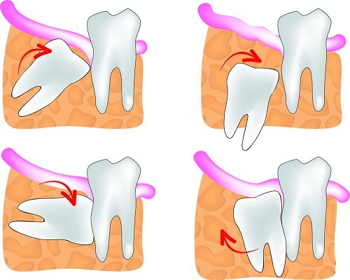 Mọc 4 cái răng khôn cùng lúc phải làm sao? 3