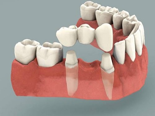 Làm cầu răng sứ giá bao nhiêu? Giá dịch vụ 1