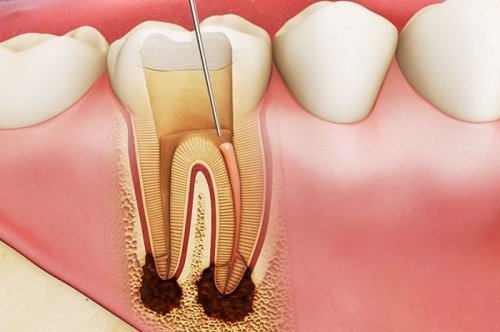 Răng sứ bị ê buốt - Top cách khắc phục hiệu quả 2