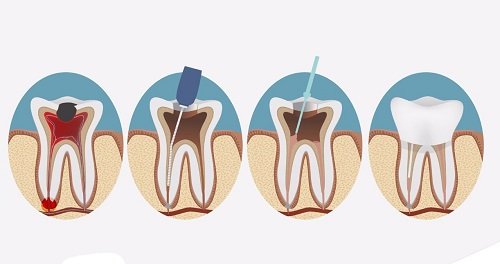 Răng sứ bị ê buốt - Top cách khắc phục hiệu quả 3