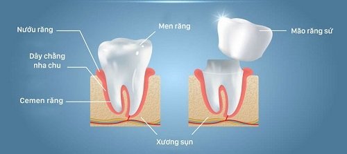 Bọc răng sứ có được vĩnh viễn không? Tìm hiểu ngay 1