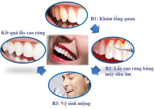 Lấy cao răng có ảnh hưởng không? Tìm hiểu về cao răng 3