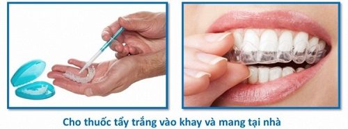 Tẩy trắng răng bằng máng có tốt không? Thực hư ra sao? 2