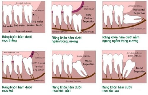 Nhổ 2 răng khôn hàm trên có nguy hiểm không? 3