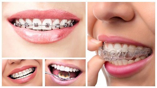 Trồng răng giả có niềng được không? Đâu là lời giải đáp đúng 3