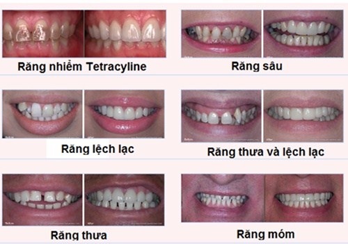 Làm răng sứ phải kiêng gì không? Tham khảo ngay 2